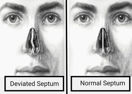 Deviated Nasal Septum- Nose Snoring Main Cause
