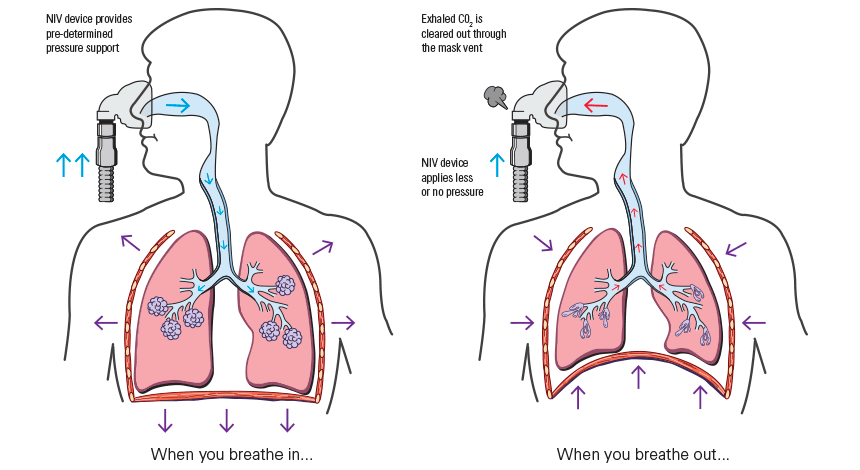 COPD symptoms and treatment guide